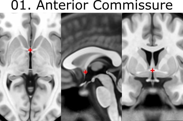 01. Anterior Commissure
