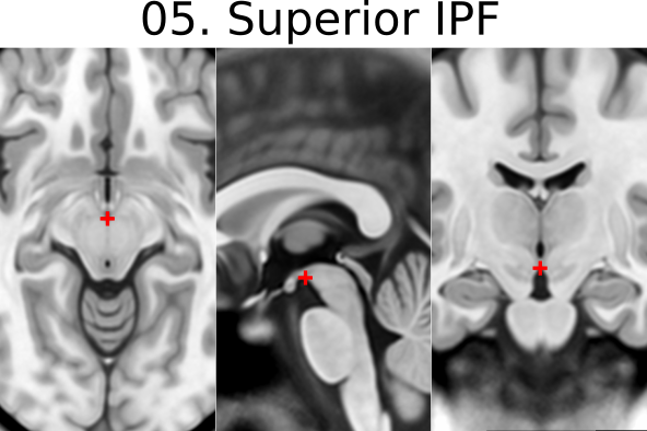 05. Superior Interpeduncular Fossa