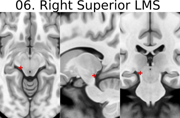 06. Right Superior Lateral Mesencephalic Sulcus