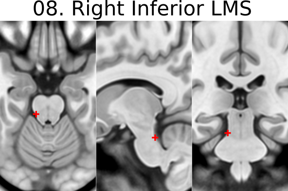08. Right Inferior Lateral Mesencephalic Sulcus