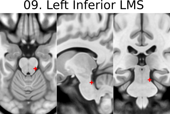 09. Left Inferior Lateral Mesencephalic Sulcus
