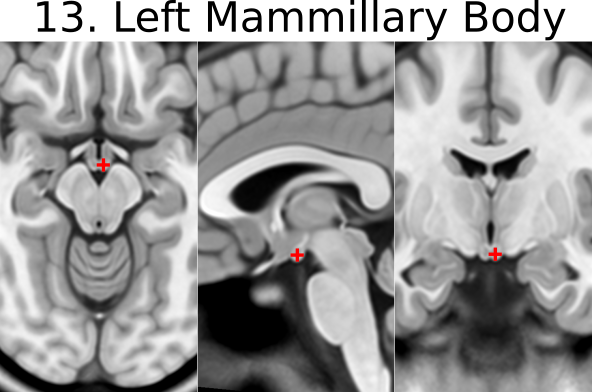 13. Left Mammillary body