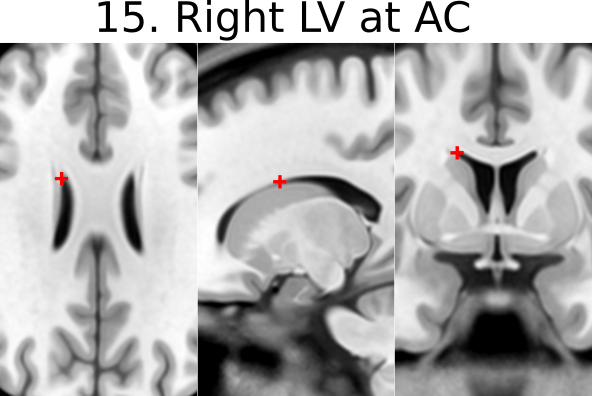15. Right Lateral Aspect of Frontal Horn on Coronal Section of AC