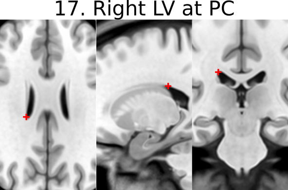 17. Right Lateral Aspect of Frontal Horn on Coronal Section of PC