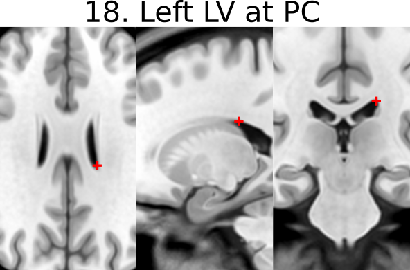 18. Left Lateral Aspect of Frontal Horn on Coronal Section of PC