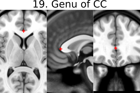 19. Genu of Corpus Callosum