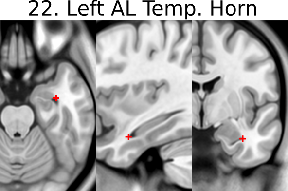 22. Left Anterolateral Temporal Horn