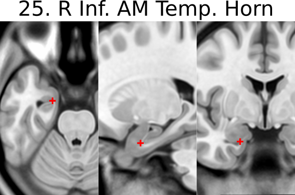 25. R inferior AM temporal horn