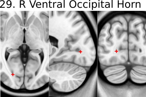 29. R ventral occipital horn