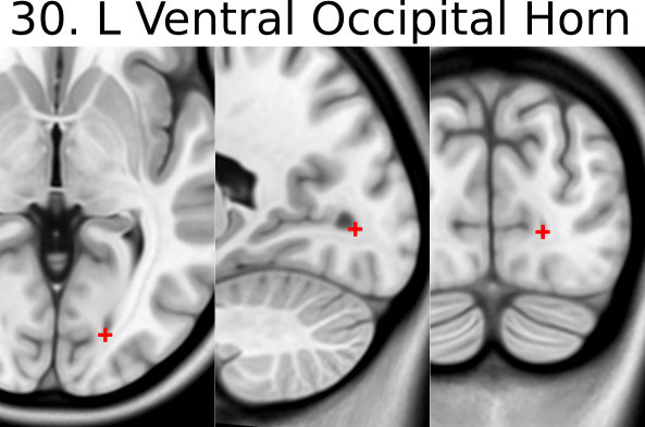 30. L ventral occipital horn