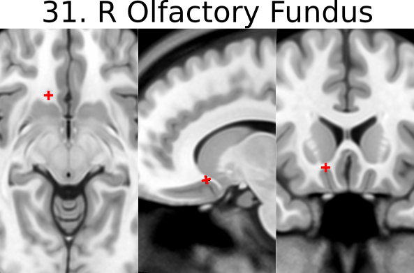 31. R olfactory sulcal fundus