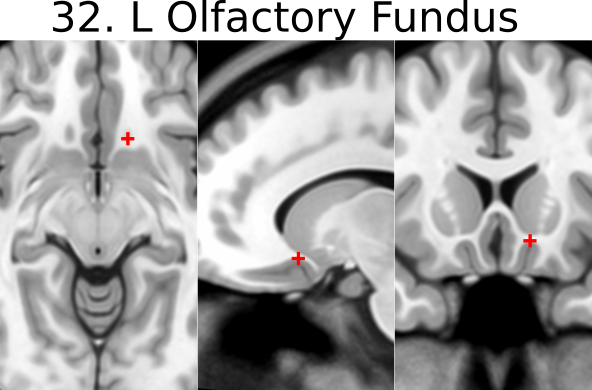 32. L olfactory sulcal fundus